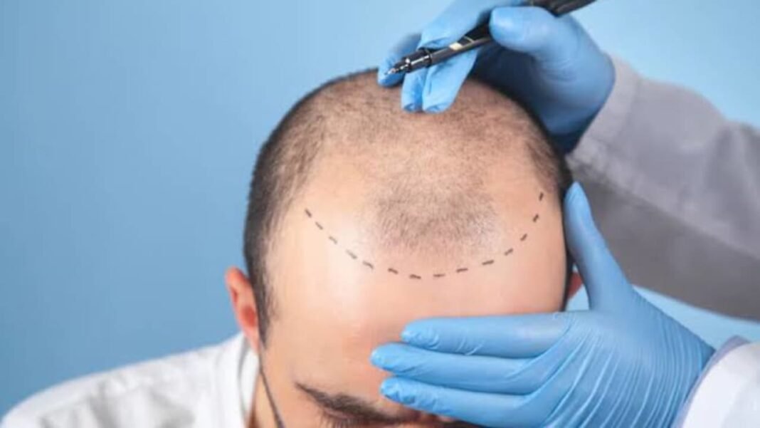 Hair transplant clinics in Dubai: Treatments, techniques, and top providers