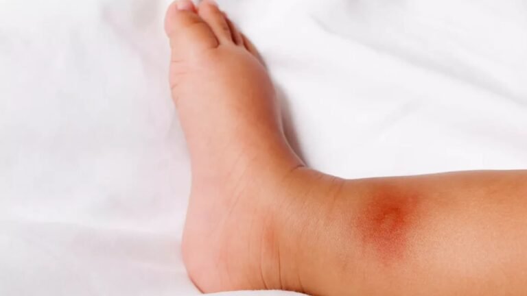 How will you know if a mosquito bite is dangerous?